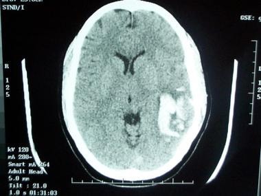 计算机断层扫描(CT)显示左侧