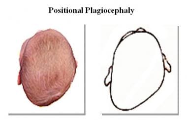 Positional plagiocephaly. Note anterior position o