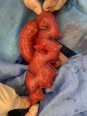 Intestinal obstruction in the newborn. In a baby w