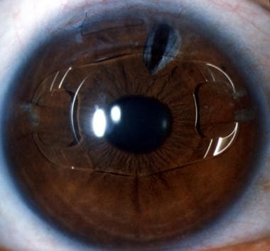 aciol anterior chamber iol piece