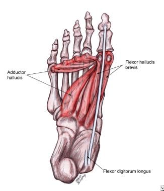 Hallux Valgus Background Anatomy Pathophysiology - 