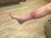 Stasis Dermatitis