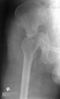 T-shaped fracture (break in the margins of the obt