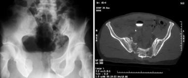 Pelvic Fractures Workup: Laboratory Studies, Imaging Studies