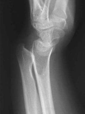 Preoperative lateral radiograph of wrist from pati