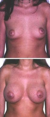 (Above) A 24-year-old woman with an A-cup breast. 
