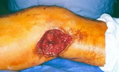 Large wound with extensive damage to the femur and