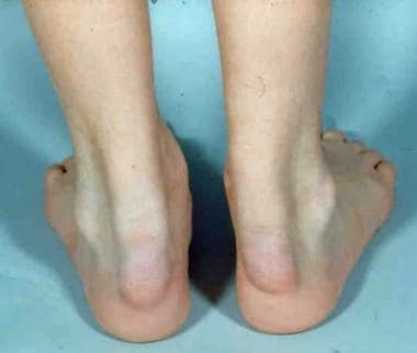 Xanthomas of the Achilles tendon. Photo courtesy o