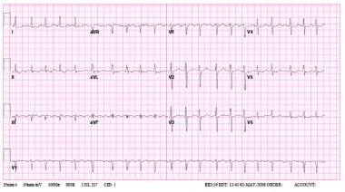 paroxysmal atrial flutter icd 10