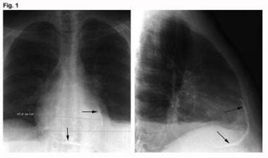 Constrictive Pericarditis. These images are antero