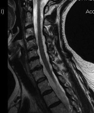 Cervical spine MRI demonstrating cervical disk dis