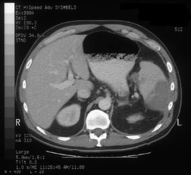 Computed tomography scan of the spleen 5 days afte
