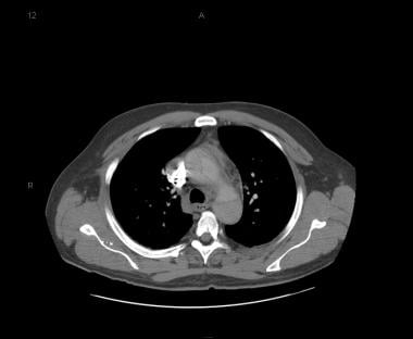 Patient with a type A aortic dissection involving 