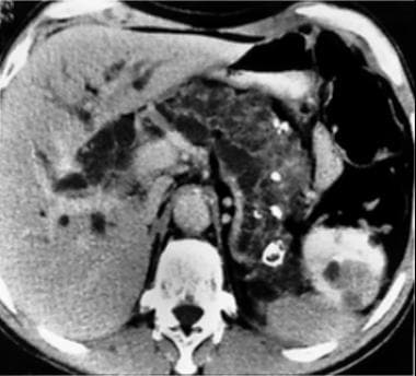 Complete replacement of the pancreas with cystic d