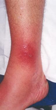 Patient with cellulitis of the left ankle. This ce