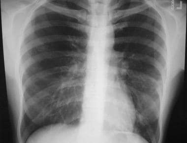 A 38-year-old patient with Mycoplasma pneumonia. C