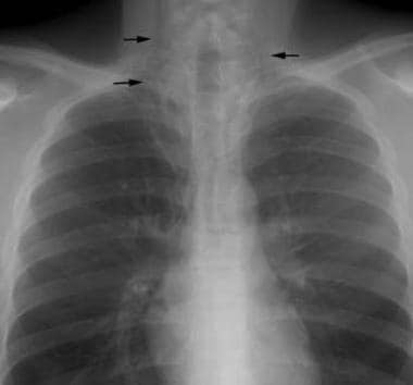 tension pneumothorax mediastinal shift