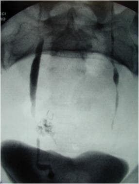Dual injury during hysterectomy. Combination trans