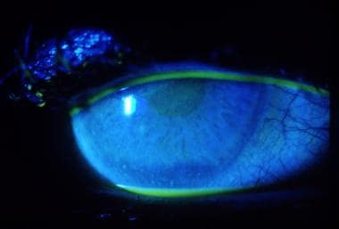 Diffuse uptake of fluorescein stain as seen in ult