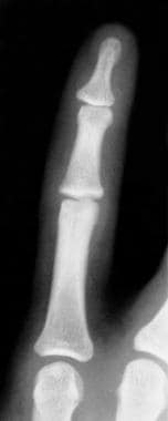 Anteroposterior view of distal interphalangeal (DI