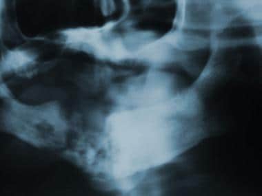 This is the panoramic radiograph of the patient se
