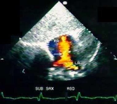 Color Doppler echocardiographic picture taken from