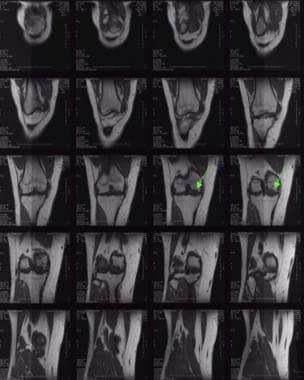 Anteroposterior MRI of medial femoral condyle oste
