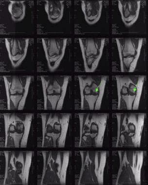 股骨内侧髁骨的正位MRI