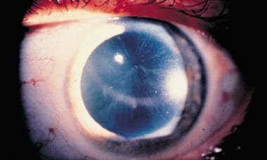 Corneal verticillata, commonly seen in patients wi