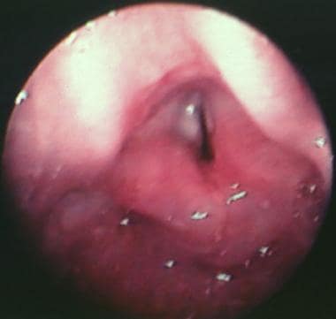 Preoperative view of glottic stenosis and small gl