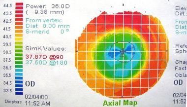 Corneal topography is useful for evaluating both t