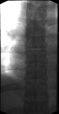 Fluoroscopy with wire in superior vena cava. 