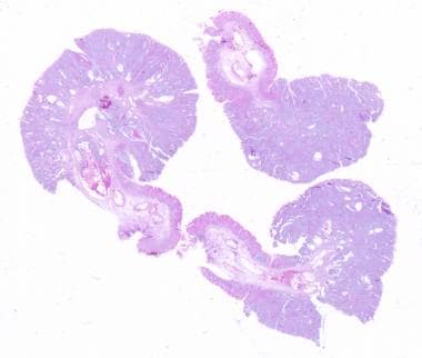 Peutz-Jeghers Syndrome. Intestinal polypoid adenom