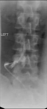 Image from a fluoroscopic-guided nerve root block 