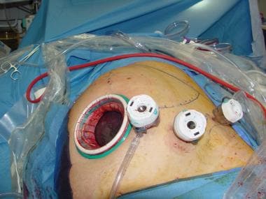 Hand-assisted laparoscopic splenectomy. Enlarged s