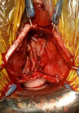 Total Autologous Fascia Lata Anterior and Apical Pelvic Organ Prolapse  Repair: A New Technique and Initial Experience - ScienceDirect