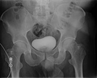Excretory urography imaging sequence: A coned down