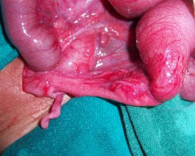 Intestinal atresia with dilated proximal loop and 