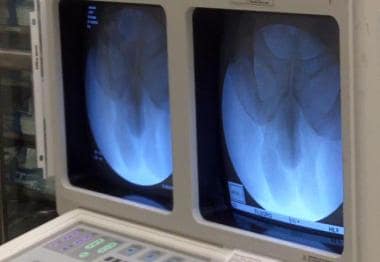 X-ray viewing setup for a retrograde urethrogram w