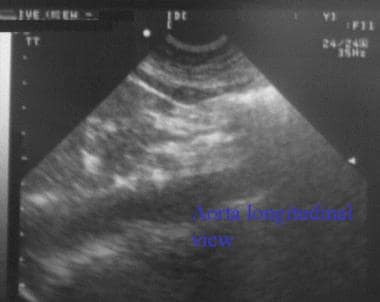 Longitudinal view of abdominal aorta (black stripe