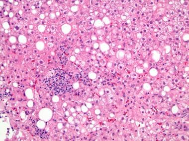 This image shows steatohepatitis with steatosis an