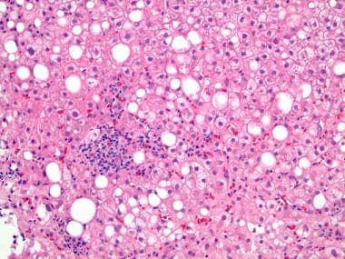 fatty liver histology