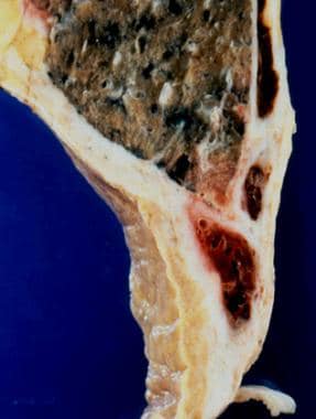 Pathology of nonmesothelial cancers of the pleura.