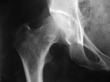 This radiograph demonstrates osteoarthritis of the