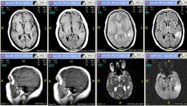 Grade III astrocytoma in a 71-year-old man. Top ro