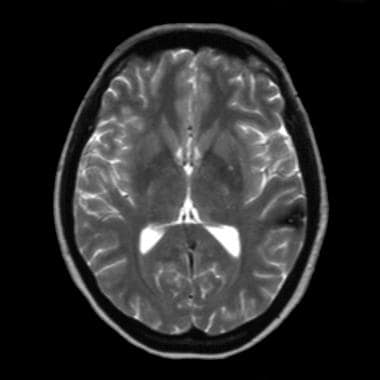 T2-weighted MRI demonstrates the hypointense bloom