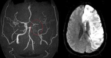 MRA in the same patient (left) demonstrates occlus