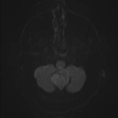 Diffusion weighted MRI of the posterior fossa meni