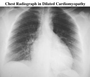 Five-year follow-up chest radiograph in a patient 