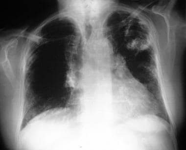 Posteroanterior chest radiograph shows chronic, ca